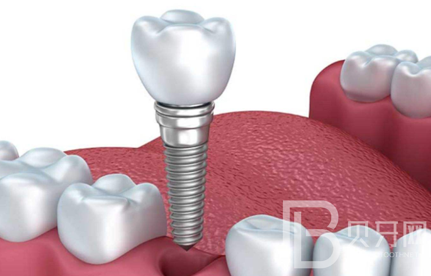 关于种植牙的常见误区，你知道几个？