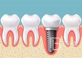 种植体牙周维护