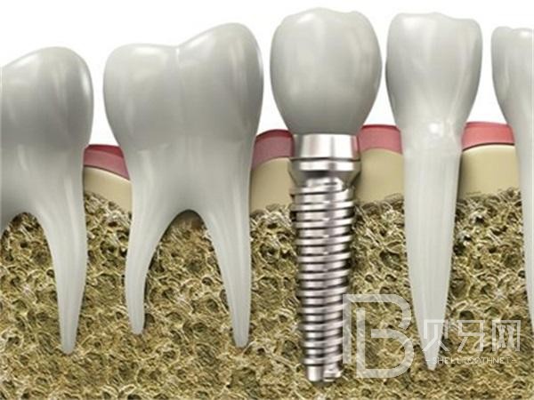 种植牙应该如何维护呢
