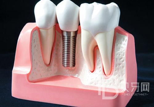 关于种植牙，你应该要了解的事项！