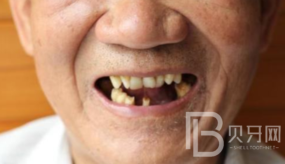 种植牙什么时候做最好，种植牙有没有年龄限制？