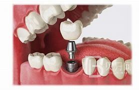 什么情况可以做种植牙？