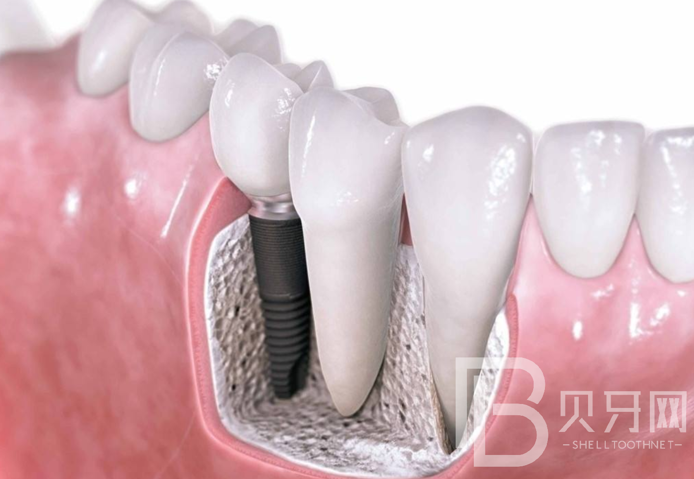 种植牙是怎么种植的，种植牙之前需要做哪些准备呢？