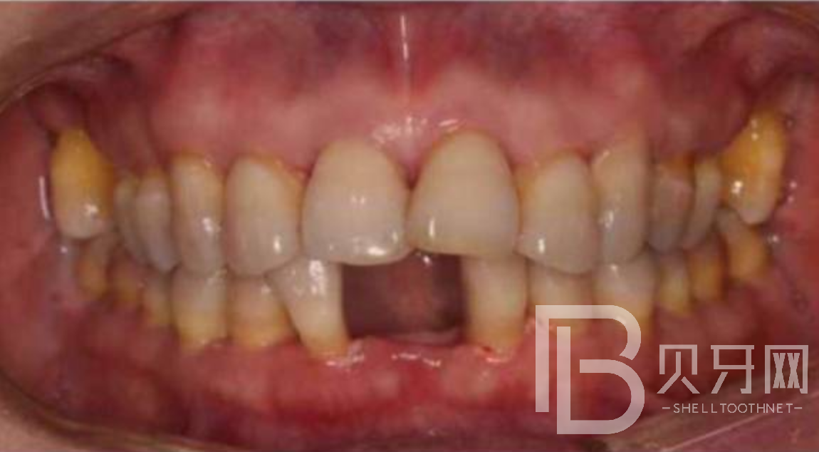 为什么单颗牙缺失要尽快修复？