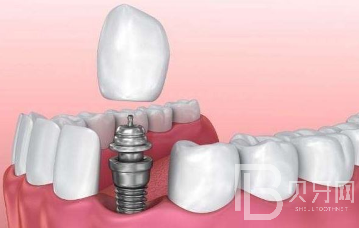 种植牙之前一定要知道的三个问题，第二个很重要！