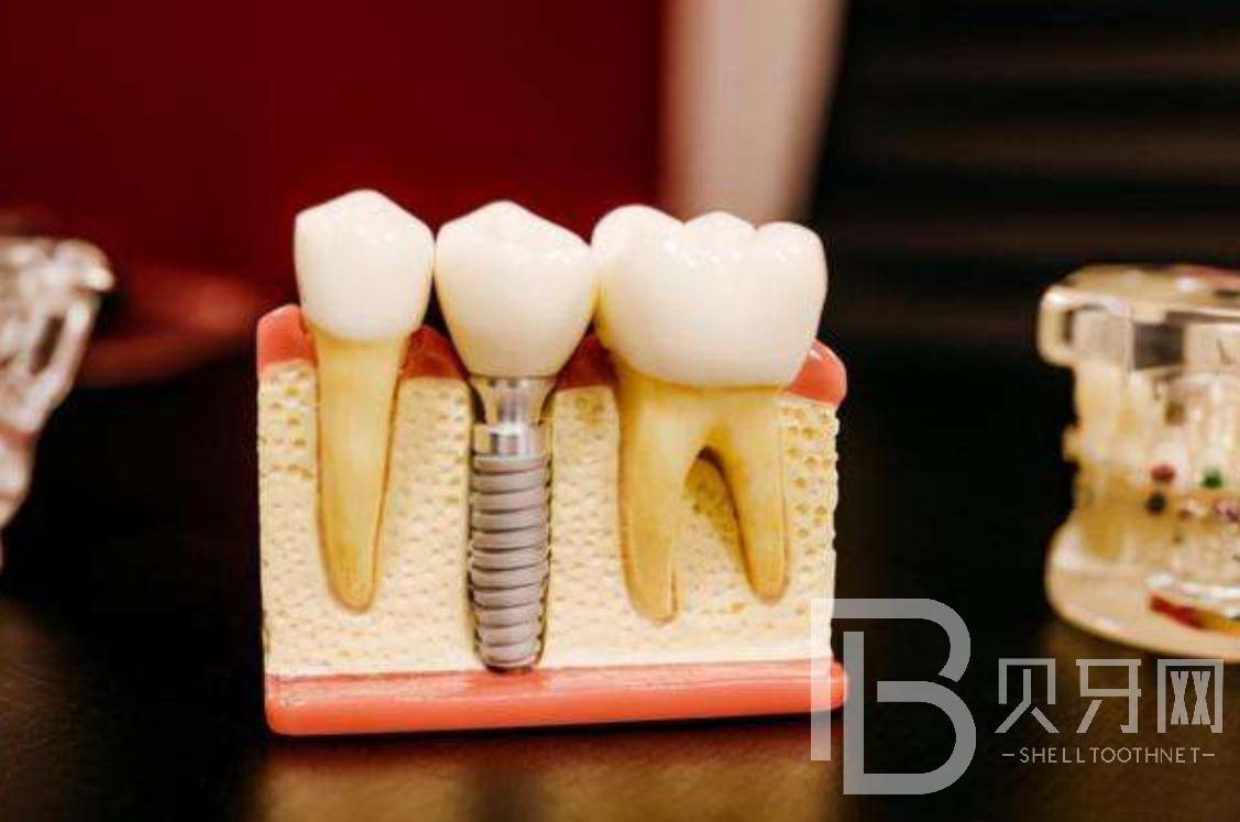 种植牙是怎么种植的，种植牙需要多长时间？