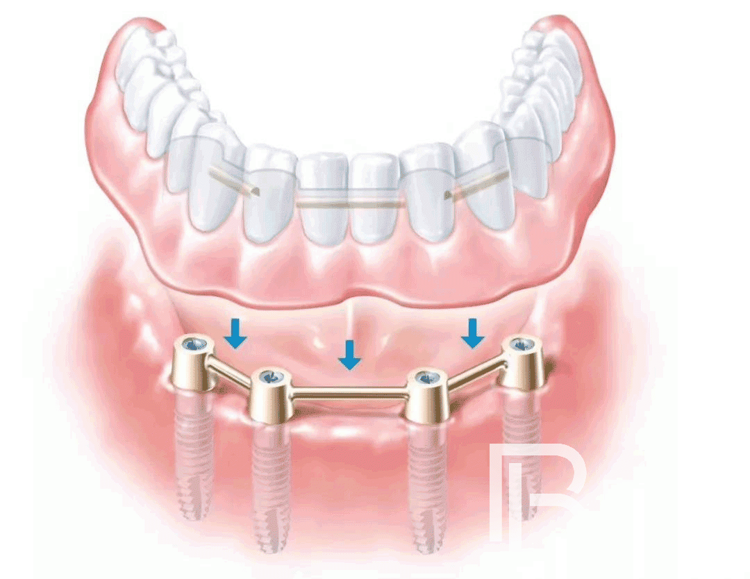 种植牙知识科普：All-on-4种植牙的几个常见问题！