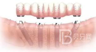 北京中诺口腔all-on-4种植牙的利与弊