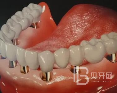 广州广大口腔老年人种植牙价格，全口种植牙需要种几棵