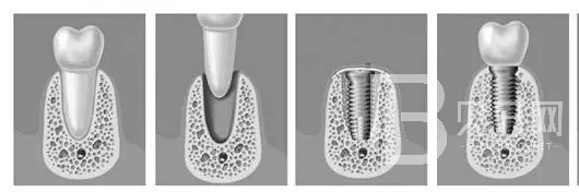 深圳瑞尔口腔半口种植牙即刻负重