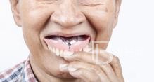 老年人适合的种植牙吗？北京圣贝口腔怎么样？