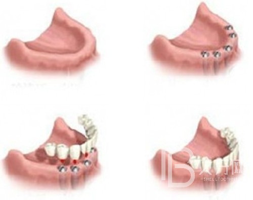 即拔即种植牙的条件？北京壹加壹口腔怎么样？