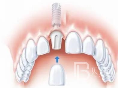 广州全家福口腔怎么样？广州全家福口腔种植牙一颗多少钱