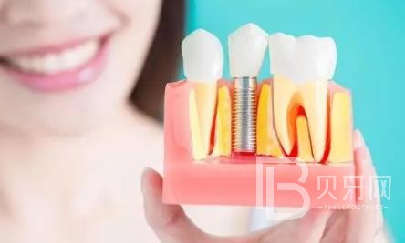 广州全明口腔怎么样？广州全明口腔种植牙一颗多少钱