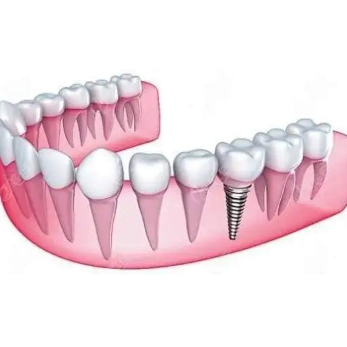 杭州种植牙价钱表！杭州闻喜淇杰口腔医院(余杭古墩路口腔诊所)种牙超划算，韩国登腾种植体：2839元起/颗！