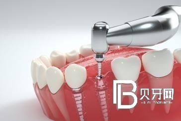 种植牙全口牙需种多少颗牙？北京维乐口腔全口种植牙技术好吗？