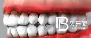 牙龈萎缩了还可以做种植牙吗？北京美莱口腔种植牙技术怎么样？