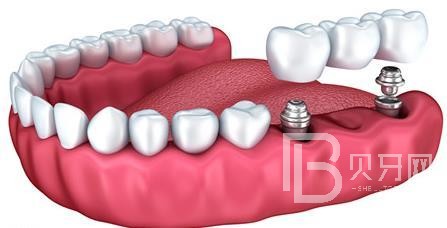 什么是半口种植牙？东莞国贸口腔来回答