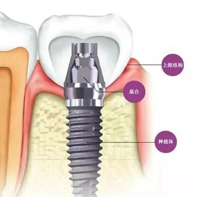 贵阳人工种植牙价钱多少！云岩美尔迪口腔诊所种植牙价格表，国产康德泰种植牙价格：3535元起/颗！
